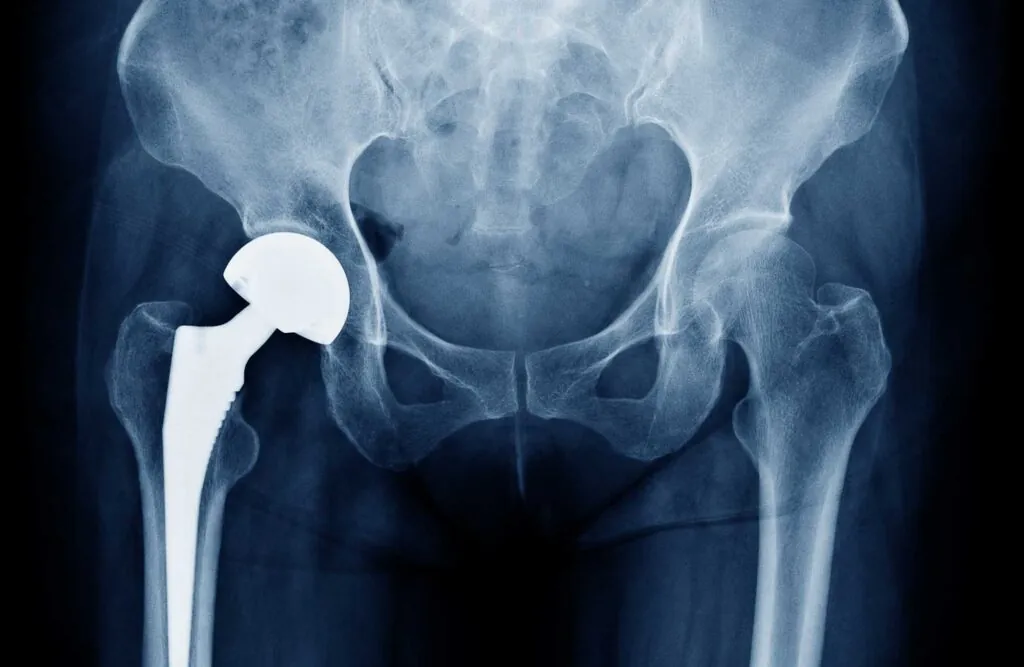 Hip replacement patient